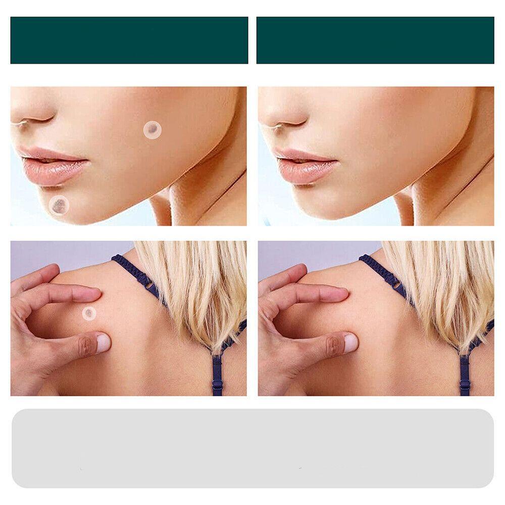 Vivolux | SkinClear - Pflaster zur Entfernung von Flecken und Warzen