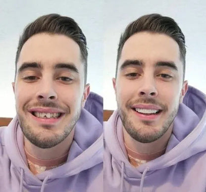 Vivolux | On Smile Veneers (Ober- und Unterkiefer inbegriffen)