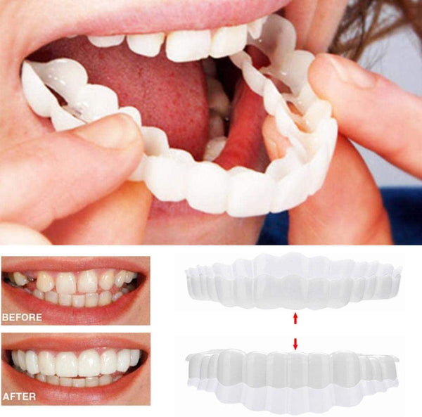 Vivolux | On Smile Veneers (Ober- und Unterkiefer inbegriffen)