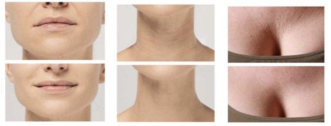 Vivolux | Anti-Falten Silikon-Pads