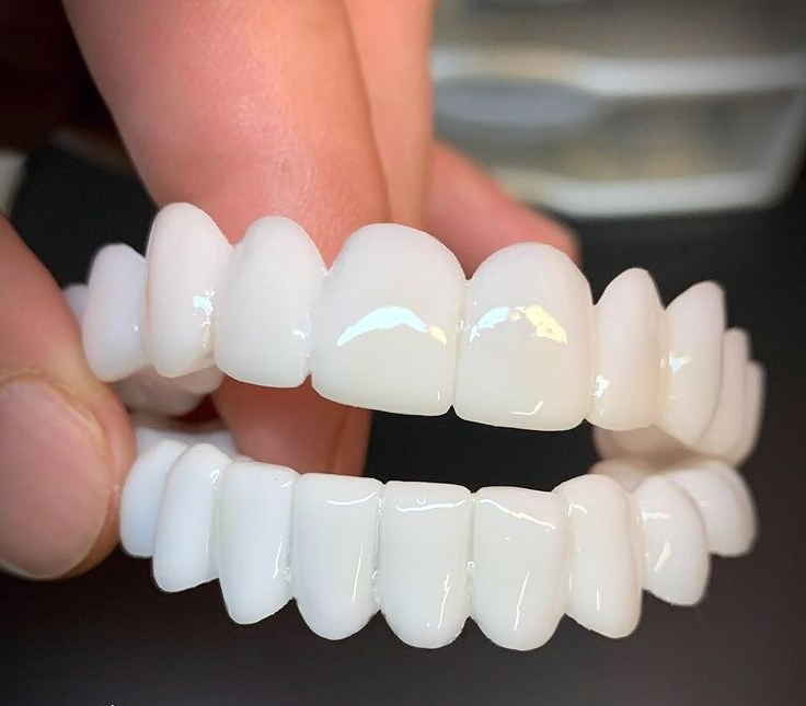 Vivolux | DentAlign Dental Veneers – Natürliche Passform und Komfort
