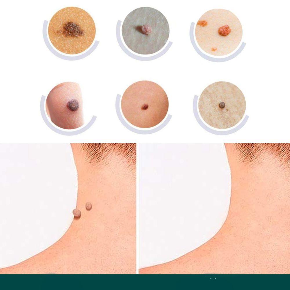 Vivolux | SkinClear - Pflaster zur Entfernung von Flecken und Warzen