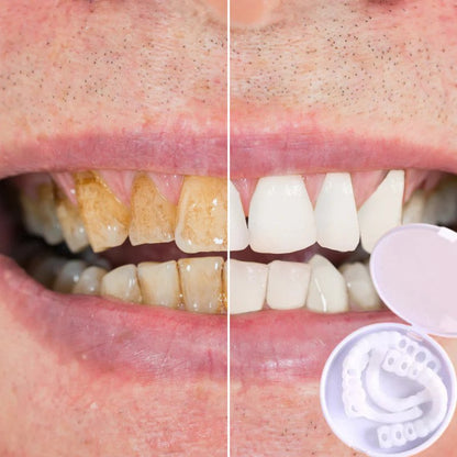 Vivolux | SmileSnap - Immer das perfekte Lächeln mit diesen Veneers